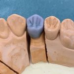 Why Lost-Wax Casting Still Matters in Modern Aesthetic Dental Prosthetics